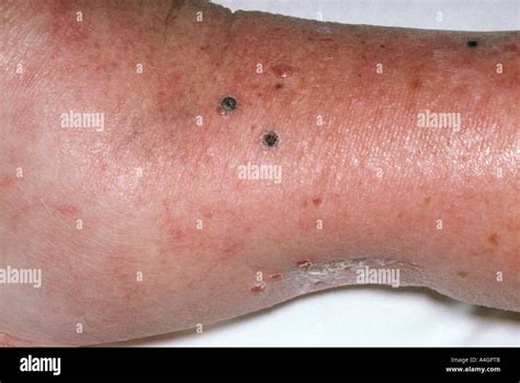 Malignant Melanoma Is A Serious Form Of Skin Cancer Stock Photo Alamy
