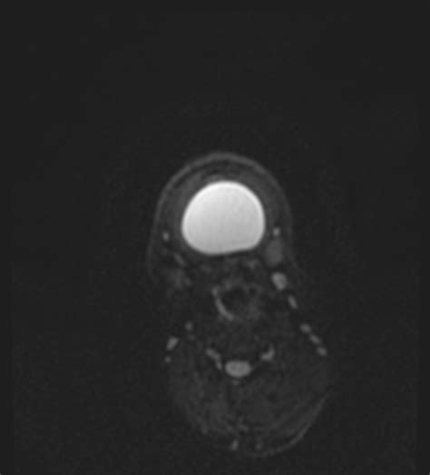 Submental Dermoid Cyst Image