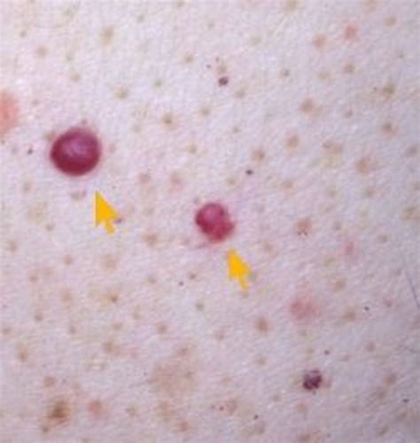 Cherry Angiomas Natural Treatments Best Resources For Treating It
