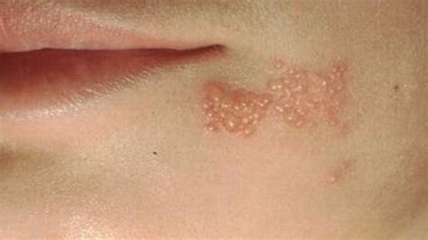 Both cause sores along with a few other symptoms. HSV-1 - Symptoms & Causes