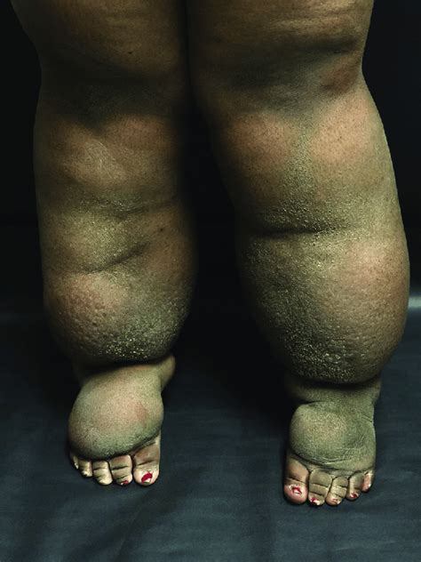 Bilateral Limb Swelling In A Morbidly Obese Female Patient