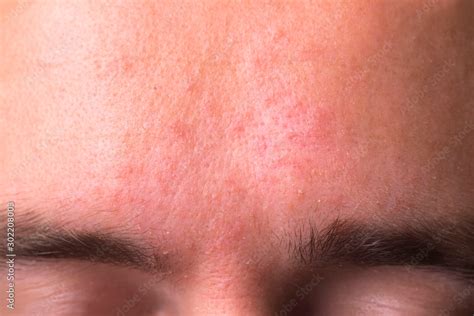 Weeping Eczema In The Stage Of Exudation Closeup Of Forehead Area With
