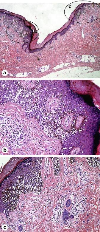Markedly Atypical Melanocytes Arranged In Irregular Nests And Solitary