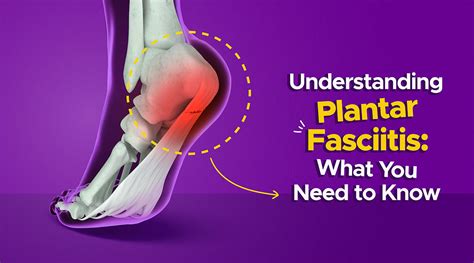 Understanding Plantar Fasciitis What You Need To Know Myfrido