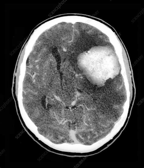 What Is A Ct Scan Of The Brain