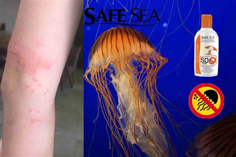 How To Treat A Jellyfish Sting Safe Sea Official Sunscreen Shop