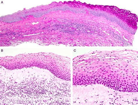 Biopsy Of Pallor At Vestibule Consistent With Lichen Sclerosus A