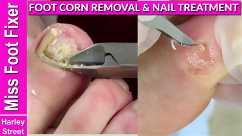 Foot Corn Removal Full Treatment By Miss Foot Fixer Marion Yau Youtube