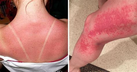 Signs Your Sunburn Is Actually Sun Poisoning