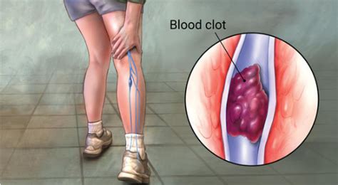Deep Vein Thrombosis Risks And Treatment St Louis Laser