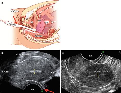 the use of color doppler ultrasound with transvaginal probe