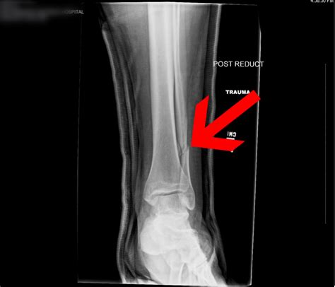 Broken Leg Tibia And Fibula Settlement Amounts Car Accidents And More