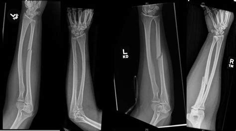 Forearm Fractures May Signal Intimate Partner Violence Axis Imaging News
