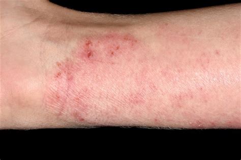 Mit hilfe eines allergietests kann die ursache bestimmt und eine. Fotogalerie: Atopický ekzém