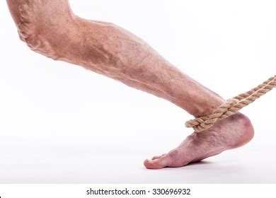 Human Leg Blocked Veins Thrombosis Phlebitis Foto Stok 330696932