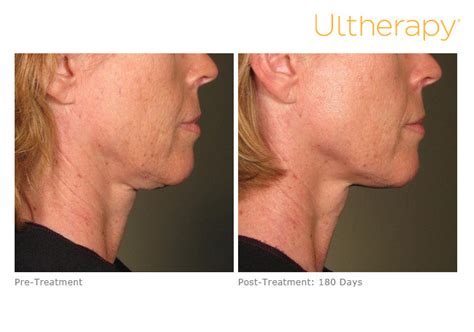 Ultherapy Nyc Tribeca Skin Center Face Tightening Lifting Non Surgical