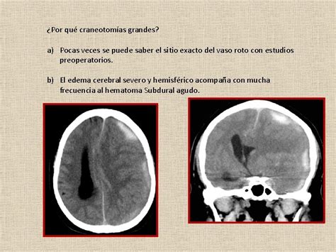 Tratamiento Quirrgico De El Hematoma Subdural Agudo Dr