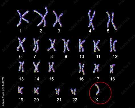 Turners Syndrome Karyotype Labeled X Karyotype D Illustration