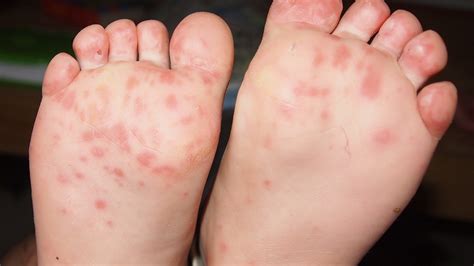 Itchy Rash On Feet Causes And Treatment Sharing Is Power Ngumpi