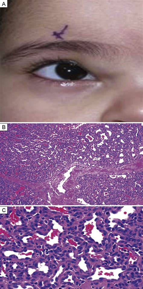 Periorbital Lesions Misdiagnosed As Dermoid Cysts Journal Of The