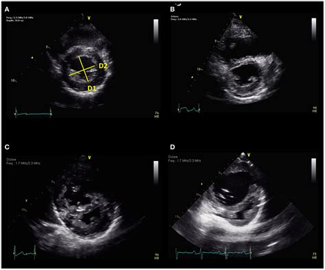 Frontiers Echocardiography In Pediatric Pulmonary Hypertension