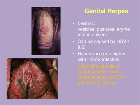 Herpes is separated into two types: Valacyclovir training south africa dr deka