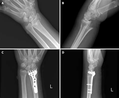Ulnar Nerve Injury Associated With Displaced Distal Radius Fracture
