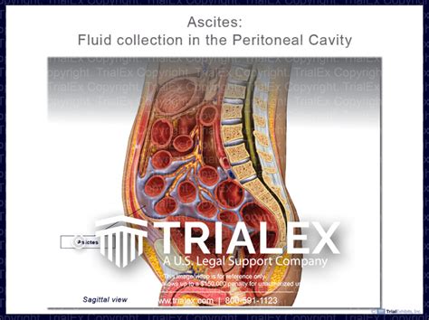 Ascites Fluid Collection In The Peritoneal Cavity Trialexhibits Inc