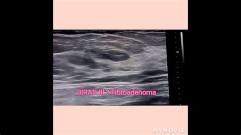 Fibroadenoma Ultrasound Youtube