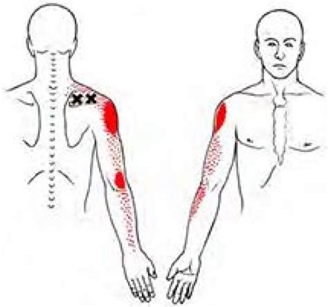 Supraspinatus Trigger Point Map Backpain In 2020 Trigger Points