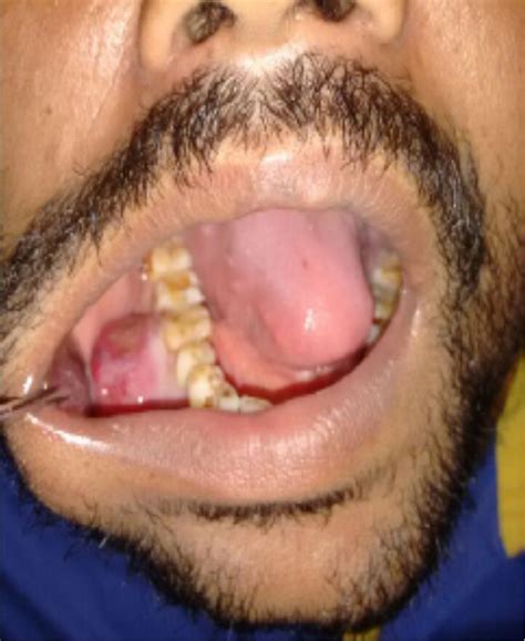 Oral Nodular Fasciitis A Case Report With A Diagnostic Schema