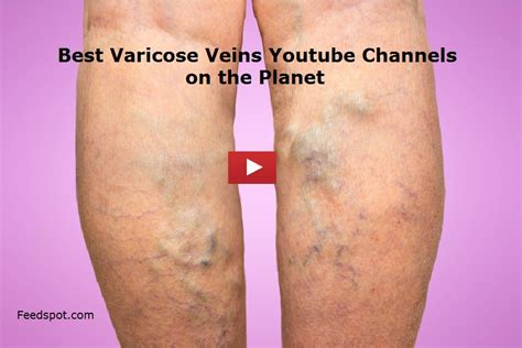 10 Varicose Veins Youtube Channels To Follow In 2023