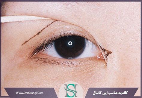 اپی کانتال جراحی بزرگ کردن چشم بهترین جراح اپی کانتوپلاستی در تهران دکتر سعید شیرنگی