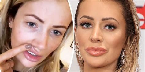 Olivia Attwood Has Top Lip Filler Dissolved And Shows Off Results