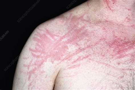 Dermatographic Urticaria Stock Image C0284401 Science Photo Library