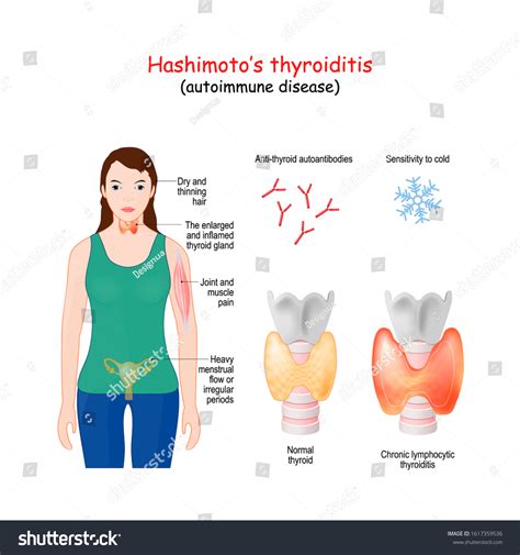Hashimotos Thyroiditis Chronic Lymphocytic Thyroiditis Autoimmune