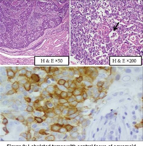 Figure 3 From Carcinoma Of Thyroid With Thymus Like Differentiation A