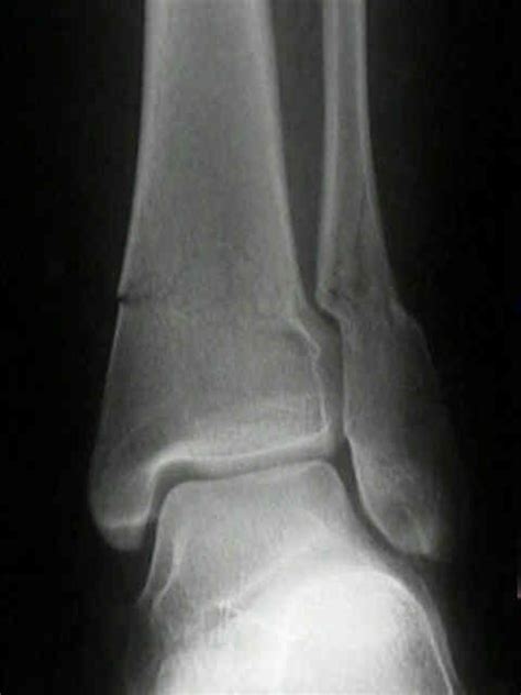 Operative Management For Fracture Of Lateral Malleolus Wheeless