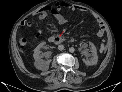 A Rare Cause Of Abdominal Pain With Fever Bmj Case Reports