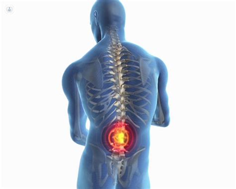 Spinal Stenosis What Is It And What Causes Flare Ups