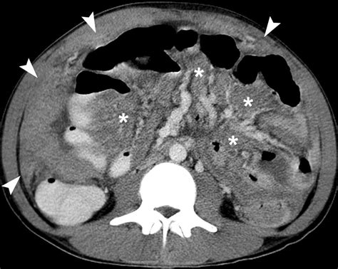 Ct Appearances Of Abdominal Tuberculosis Clinical Radiology