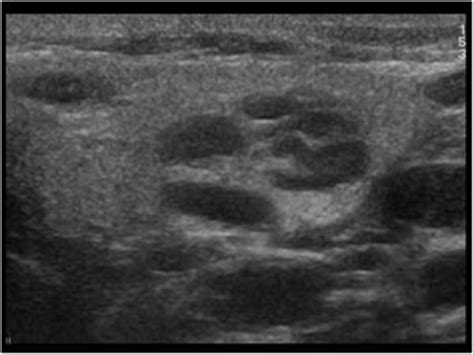 Parotid Gland Lesion Ultrasound