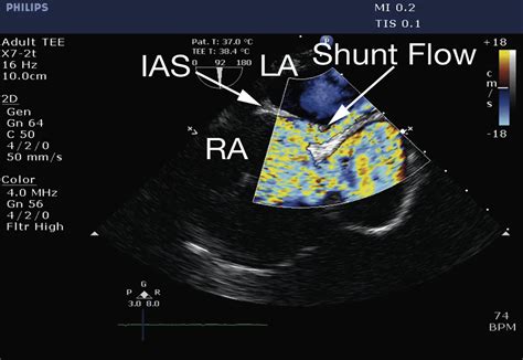 Right To Left Shunt Through Patent Foramen Ovale During Off Pump