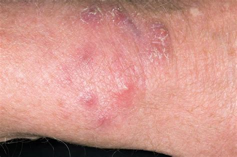 Ringworm Skin Infection Photograph By Dr P Marazziscience Photo Library