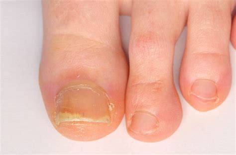 How Does Psoriatic Arthritis Affect Nails Cleveland Clinic