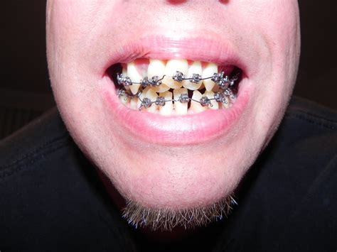 how do they put braces on crooked teeth teeth poster
