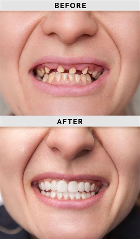 Immediate Dentures Smile Again Denture Clinic