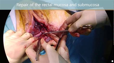Emergent Repair Of A Fourth Degree Perineal Tear Youtube