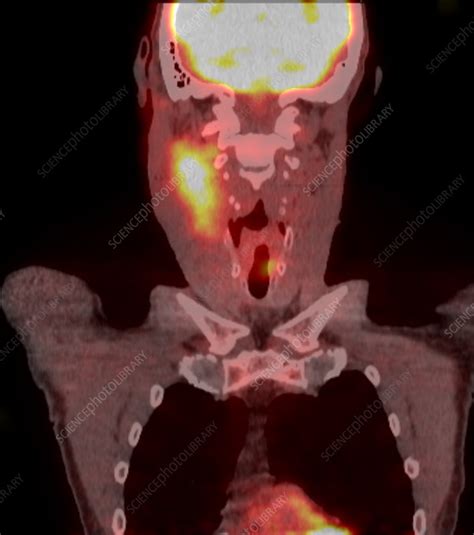 Tongue Cancer Pet Ct Scan Stock Image C0393596 Science Photo