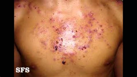 Get Rid Of Chest Pimples Youtube